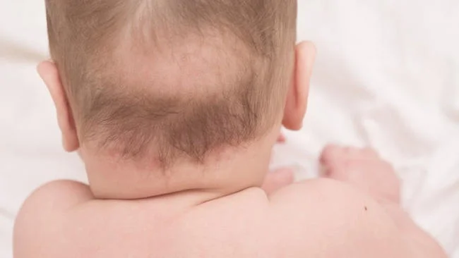 Đặc điểm các chủng nấm da đầu ở trẻ
