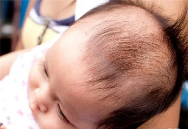 nấm da đầu ở trẻ em