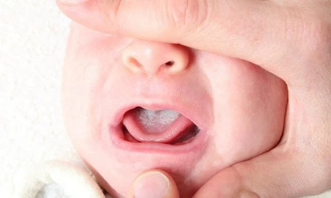 Tưa lưỡi gây đau đớn, khó chịu cho trẻ