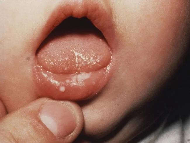 Nấm miệng ở trẻ 2 tuổi