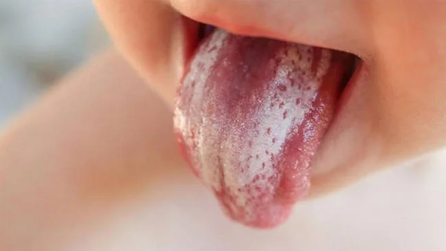 Nguyên nhân gây nấm miệng ở trẻ 2 - 3 tuổi