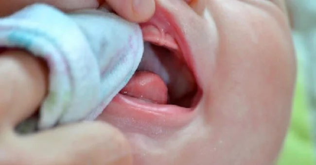 Vệ sinh miệng cho trẻ sơ sinh