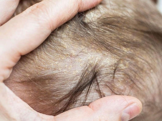 Nhận biết nấm da đầu ở trẻ em – Cần làm gì để xử lý?